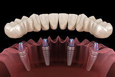 Имплантация зубов ALL-ON-4 фото