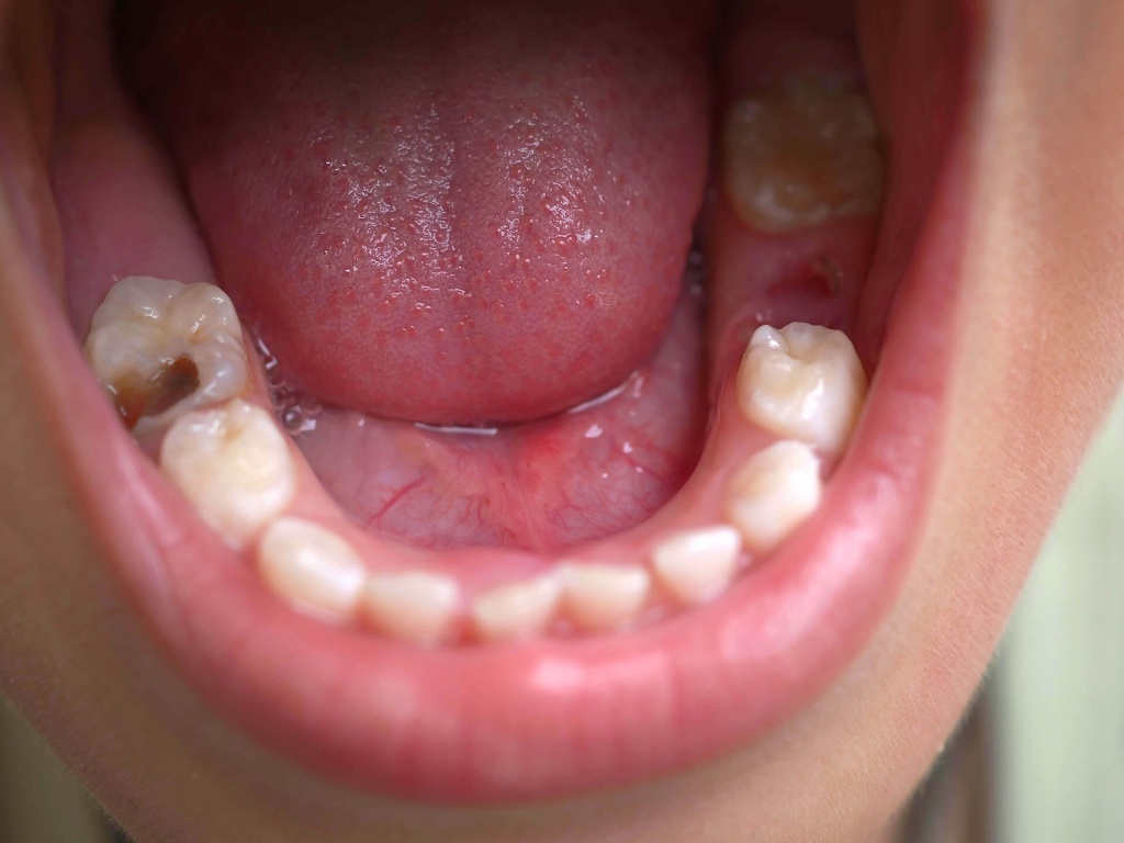 Кариес на зубе