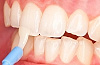 Бесплатное фторирование зубов для детей фото