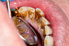 Злоупотребление сладостями и кофе приводит к устойчивому налету на зубах фото