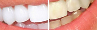 Как и чем можно отбелить зубы? фото