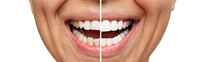 Как происходит наращивание зуба? фото