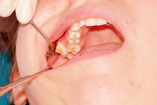 дистопия зубов