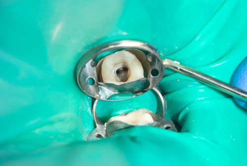 Восстановление пломбы