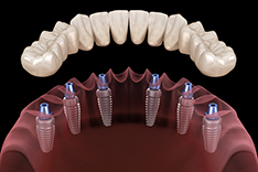Имплантация зубов ALL-ON-6 фото