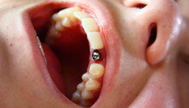 Базальная имплантация зубов фото