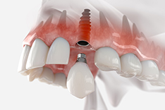 Имплантация верхних зубов фото