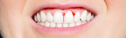 Почему кровоточат дёсна при чистке зубов? Что делать, чем и как лечить кровоточивость десен?