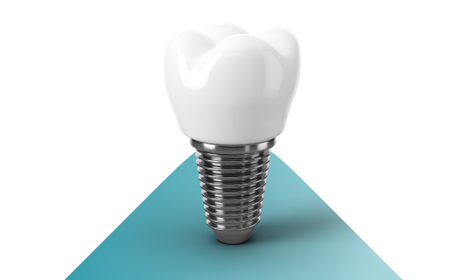 Имплантация зубов доступно и качественно
