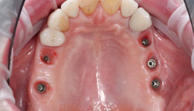 Имплантация жевательных зубов фото