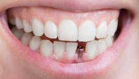 Имплантация передних зубов фото