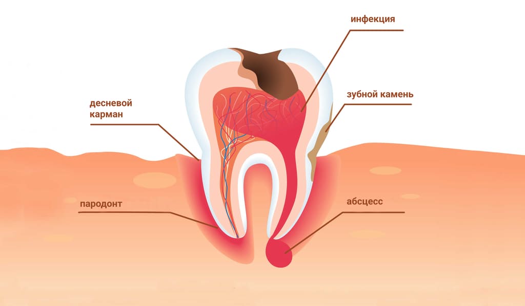 Периодонтит зуба
