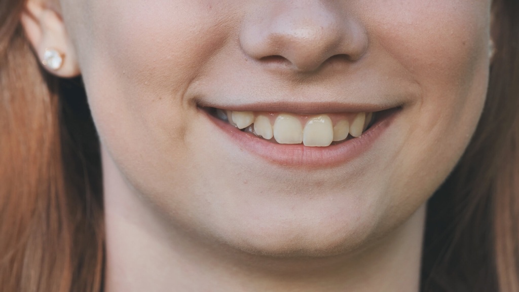 Фото искривленных зубов у ребенка №2