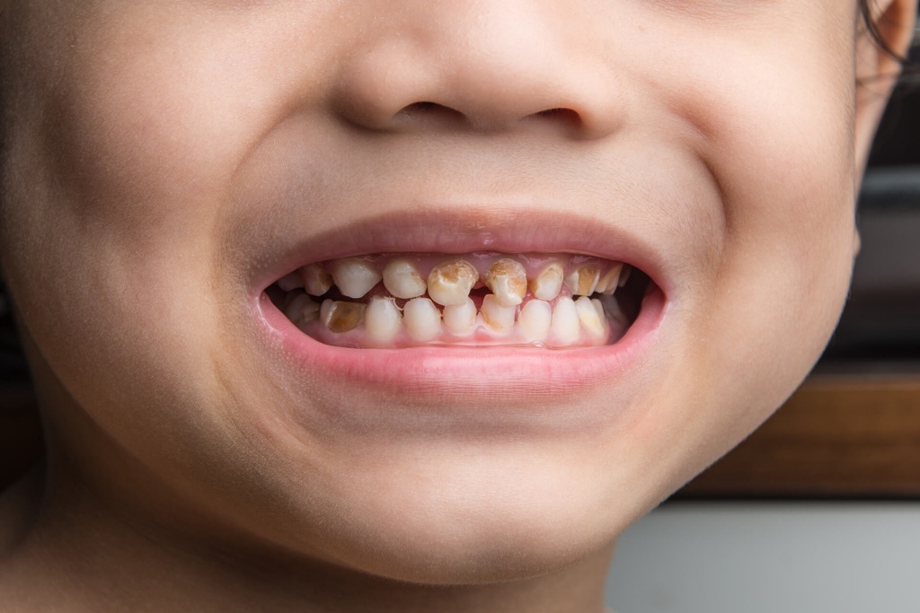 Кариозное поражение зубов ребенка