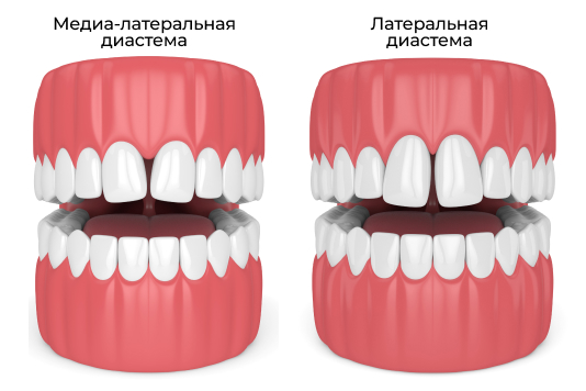 виды диастем