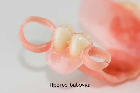 Протез-бабочка