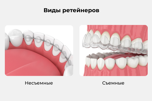 Виды ретейнеров