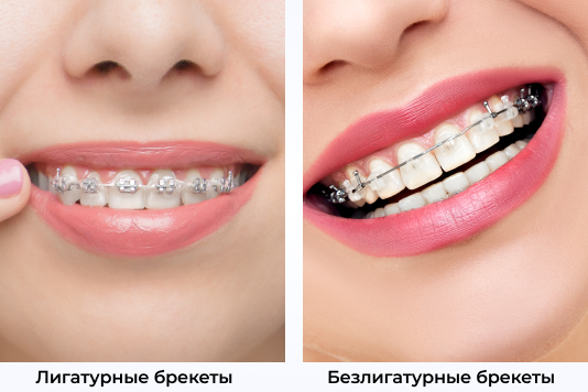 Сравнение брекетов
