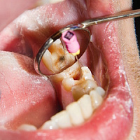 Выпала пломба — что делать? фото