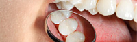Нужно ли менять пломбы в зубах? фото