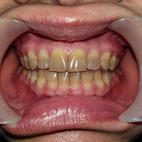 Тетрациклиновые зубы фото