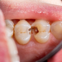 Дырка в зубе фото