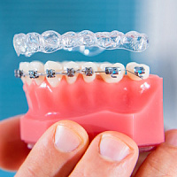 Брекеты или элайнеры - что лучше выбрать? фото