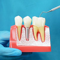 Корейские импланты зубов: виды, какие лучше выбрать фото