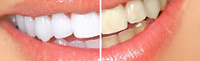 Что такое виниры в стоматологии? фото