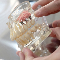 Костная пластика перед имплантацией: что это такое и когда нужна фото