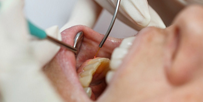 Гингивотомия фото