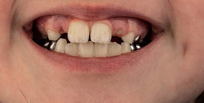Коронки на детские зубы фото