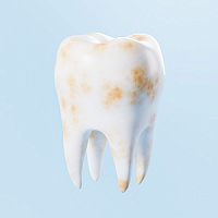 Пигментация зубов фото