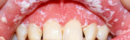 Невыносимая боль и ранки во рту: что такое стоматит и как его лечить