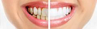 Удаляем зубной налет: 5 советов стоматолога фото