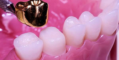 Установка коронки на зуб фото
