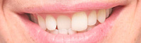 Неровные зубы фото