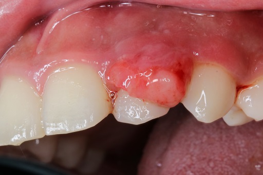 Симптомы гранулемы зуба